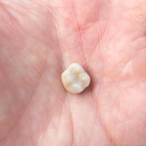 crown, iPhone, tooth